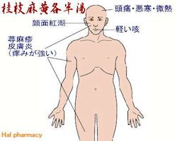 桂枝麻黄各半湯(桂麻各半湯)